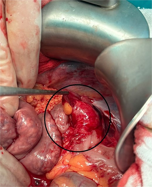 Descending colon laceration >50% (encircled).