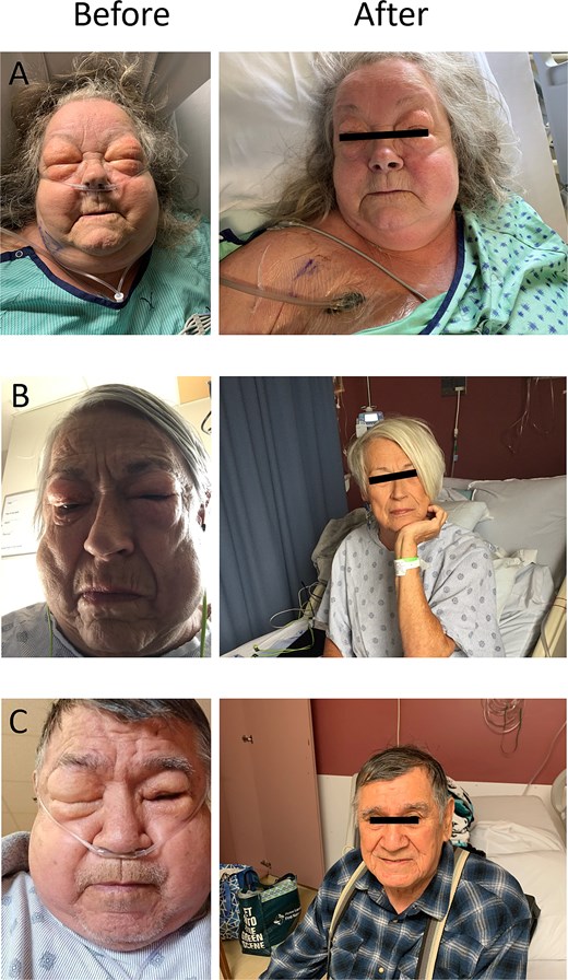 Before and after images of three patients who developed severe subcutaneous emphysema causing temporary blindness following VATS lobectomy. The “before” images demonstrate significant facial swelling and eye closure due to the accumulation of subcutaneous air. The “after” images show resolution of subcutaneous emphysema and restored vision within 12 h following the application of NPWT via a unilateral blowhole incision on the anterior chest wall. (A) 8 h after initiation of therapy. (B) 24 h after initiation of therapy. (C) 72 h after initiation of therapy.