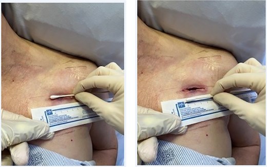Four centimeter blowhole incision on the anterior chest wall to which the NPWT was applied.