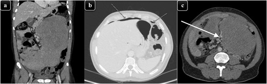 (a) A coronal view of CT abdomen showing large soft tissue density, homogenously enhancing mass predominantly occupying the left side of the abdomen and reaching to the midline approximately measuring 31 × 19 × 11.7 cm. (b) CT abdomen with an axial view, showing significant pneumoperitoneum. (c) CT abdomen with an axial view showing the mass encasing the mesenteric vessels (white arrow) in the lower abdomen with marked compression and displacement of the adjacent abdominal structures.