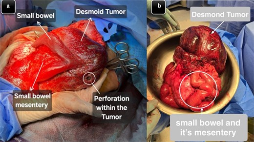 (a) An intra-operative image illustrating the mass that originated from the mesentery along with small bowel adhesion and perforation within the tumor. (b) Specimen image showing the excised well-circumscribed lesion with a smooth external surface along with a portion of the small intestine and its mesentery that was involved.