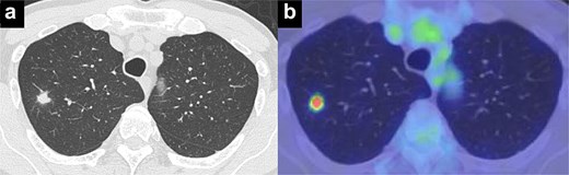Images of CT and PET show a 1.5-cm irregularly marginated solid nodule in the apical segment of the right upper lobe with a maximum standard uptake value of 4.6.