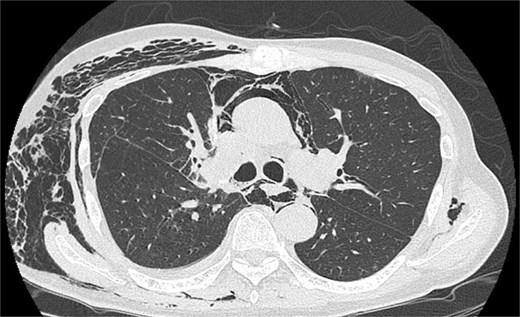 Image of postoperative CT demonstrates massive mediastinal and SE with little lung collapse.