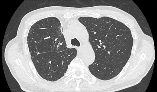 Image obtained 1 year postoperatively presents no mediastinal and SE and no recurrence of lung cancer.