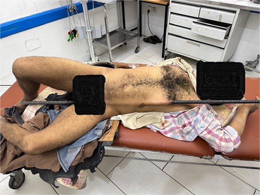 Clinical image of the patient upon arrival at the emergency department, showing a metallic rod impaling the pelvis and extending subcutaneously through the abdominothoracic region.
