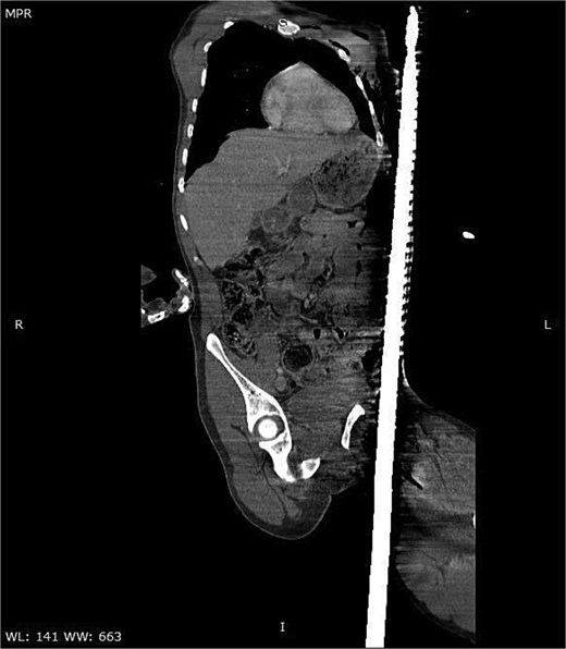 Sagittal CT image demonstrating the trajectory of the metallic rod traversing the body through the subcutaneous and epifascial planes.