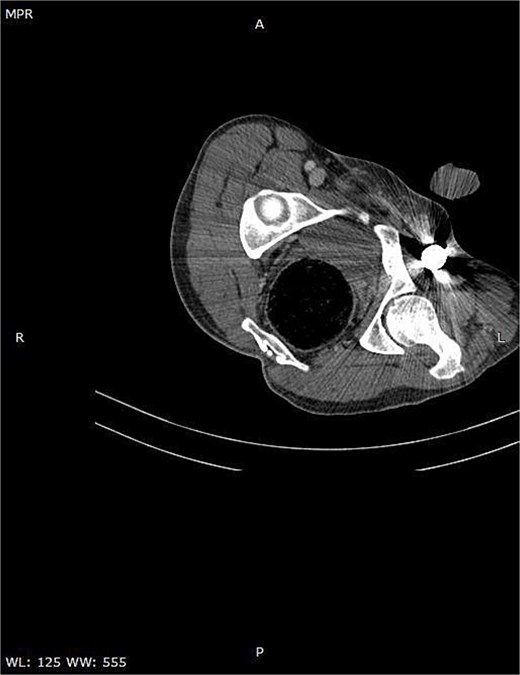 Axial CT image demonstrating the metallic rod positioned in close proximity to the femoral sheath without evidence of vascular injury.
