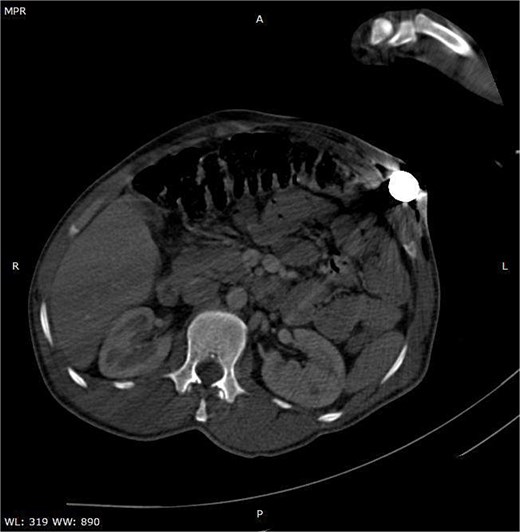 Axial CT image illustrating the entry site of the metallic rod through the abdominal wall.