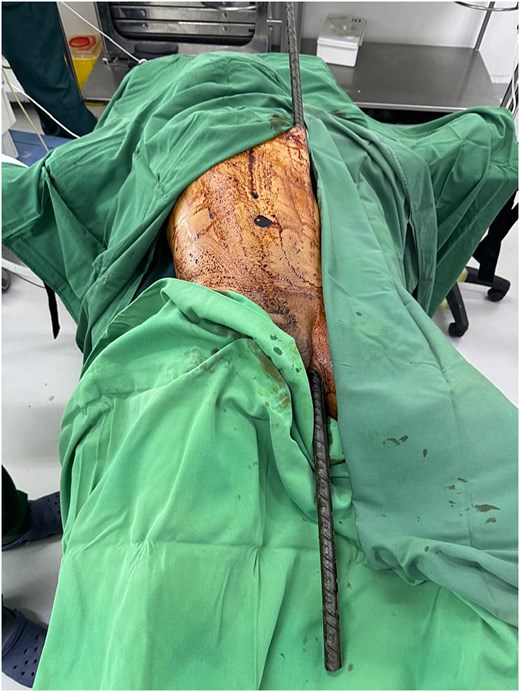 Intraoperative image showing the metallic rod traversing the patient’s body through the subcutaneous and epifascial planes.