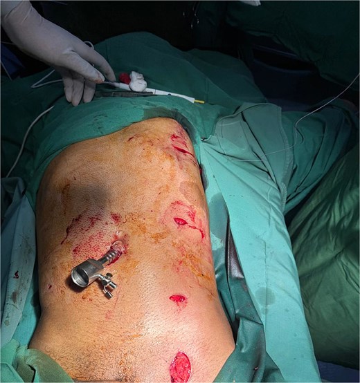 Intraoperative image demonstrating the completion of diagnostic laparoscopy and the successful extraction of the metallic foreign body.