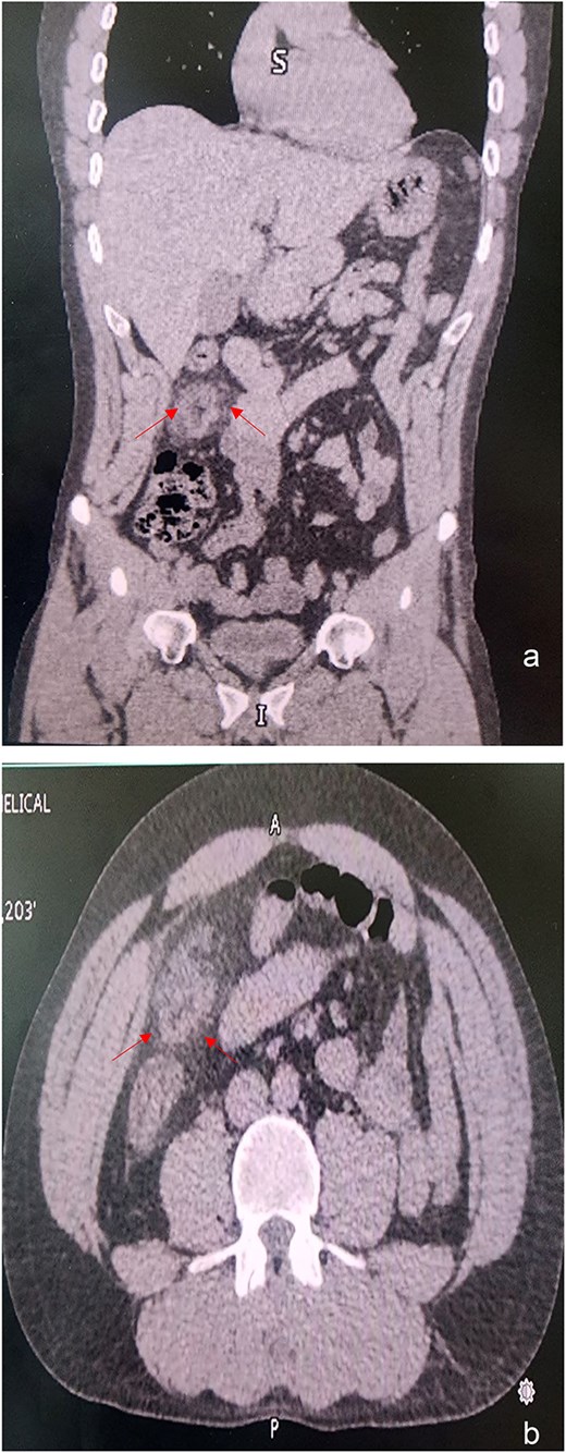 (a) A simple coronal and (b) axial CT showing the density of intra-abdominal fat on the right side was markedly increased, indicating inflammation of the greater omentum.