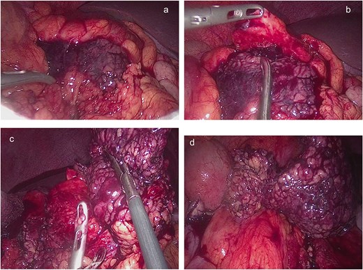 (a, b) Twisted segments of the greater omentum with necrotic-looking patches of blood clots covered with an ischemic portion of omental fat on exploring the omentum on the right side of the transverse colon. (c, d) Necrotic twisted omentum resected.