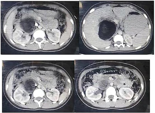 Non contrast CT showing a large hypogenous cyst of the caudate liver lobe lengthen to the hepatic hilum, dimensions of 7.7 × 9.5 cm with calcified composition of the wall.