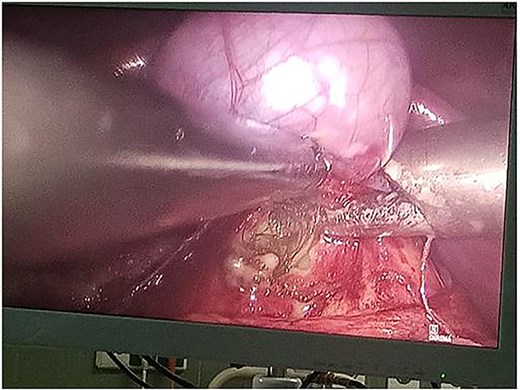 Intraoperative laparoscopic view demonstrating dissection of a hydatid cyst located in the caudate lobe of the liver. The cyst, consistent with an atypical type IV Echinococcus granulosus hydatid cyst, shows a well-defined, calcified wall. Atraumatic graspers are used to carefully mobilize the cyst from surrounding hepatic tissue near the hepatic hilum.