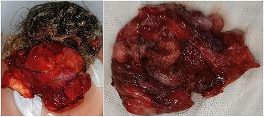 Resected specimen of the hepatic cystic mass, removed laparoscopically under vascular clamping. The excision was performed through healthy liver parenchyma, ensuring complete removal of the cyst wall. The gross appearance, featuring heterogeneous soft tissue components and hair-like structures, initially raised suspicion of a hepatic teratoma among the surgical team.