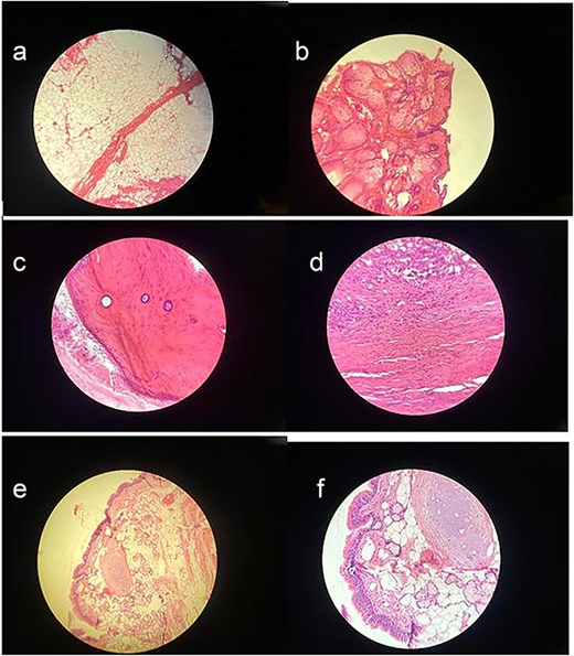 (a) Adipose tissue – This image shows large, empty-looking cells with thin borders, typical of adipocytes storing fat. (b) Squamous epithelium – Histological image showing stratified squamous epithelium (H&E stain, ×100), characterized by multiple layers of flattened cells. (c) Compact bone – This section reveals osteons with central (Haversian) canals surrounded by concentric lamellae. (d) Muscle – Histological image showing skeletal muscle tissue (H&E stain, ×100), with characteristic elongated, eosinophilic fibers and peripheral nuclei. (e) Skin adnexal structures – Histological image showing skin adnexal structures, including stratified squamous epithelium, sebaceous glands, and underlying connective and adipose tissue (H&E stain, ×100), consistent with ectodermal and mesodermal elements of a mature teratoma. (f) Cartilage tissue – H&E-stained section showing hyaline cartilage with chondrocytes in lacunae and a smooth matrix. Adjacent connective tissue and adipocytes indicate transition to surrounding structures.