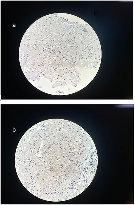 (a) Immunohistochemical staining for Synaptophysin. The sample shows a negative result for synaptophysin expression, excluding neuroendocrine differentiation within the lesion and further confirming the diagnosis of a mature cystic teratoma. (b) Immunohistochemical staining for Ki-67. The section demonstrates a low Ki-67 proliferation index, with minimal to no nuclear staining observed. This indicates low proliferative activity, supporting the diagnosis of a mature cystic teratoma.