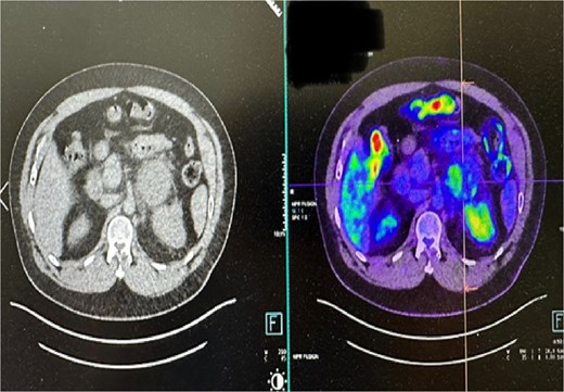 PET CT scan: minimal to mild FDG uptake in the medial aspect of enlarged left adrenal mass.