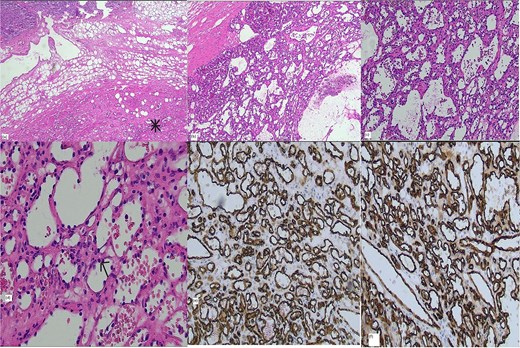 Histology: (a) Hematoxylin and eosin (H&E) stain × 2 magnification showing interface of adrenal (top) and vascular lesion (bottom), (b) H&E stain × 4 magnification (c) H&E stain × 10 magnification, (d) H&E stain × 20 magnification, positive vascular endothelial immunohistochemical markers CD 31 (e) and CD 34 (f).