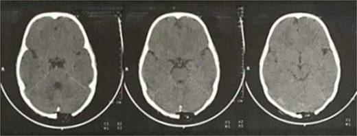 CT scan axial view of the skull.