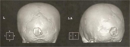 3D CT reconstruction of the skull.