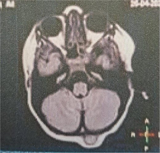 MRI T1WI axial view without contrast enhancement showing an extra-axial space-occupying mass, iso-intense and well-circumscribed in shape.