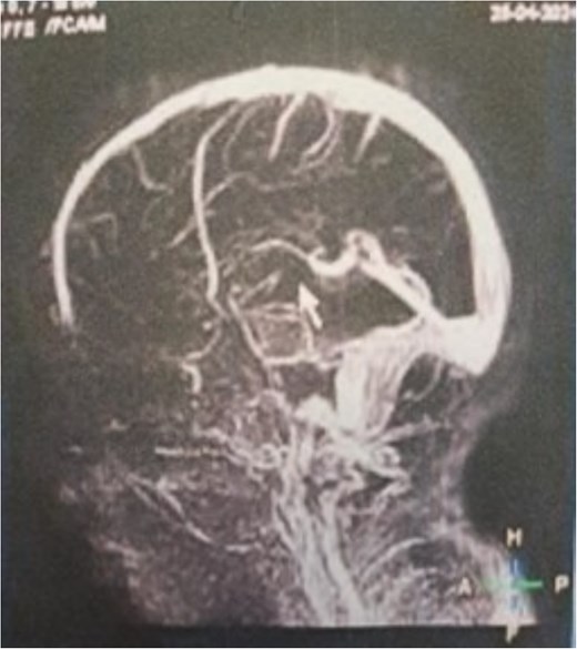 MRV sagittal view showing patent superior sagittal sinus with no encroachment of the lesion.