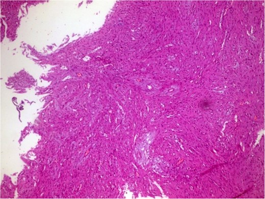 Photomicrograph in a case of NOF showing interlacing bundles of spindle-shaped fibroblasts in a storiform manner, H&E × 100.