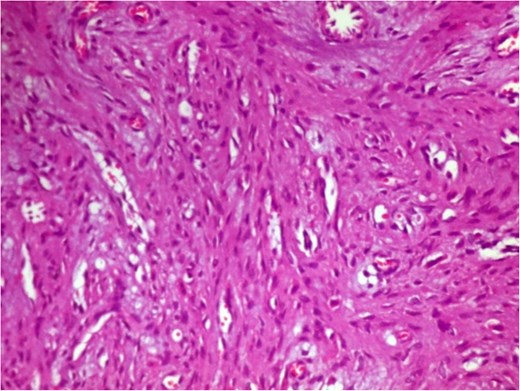 Photomicrograph in a case of NOF showing interlacing bundles of spindle-shaped fibroblasts in a storiform manner, H&E × 400.