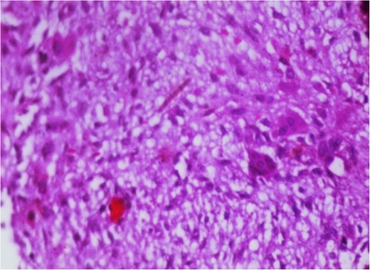 Photomicrograph in a case of NOF showing osteoclast-like giant cells, H&E original magnification × 400.