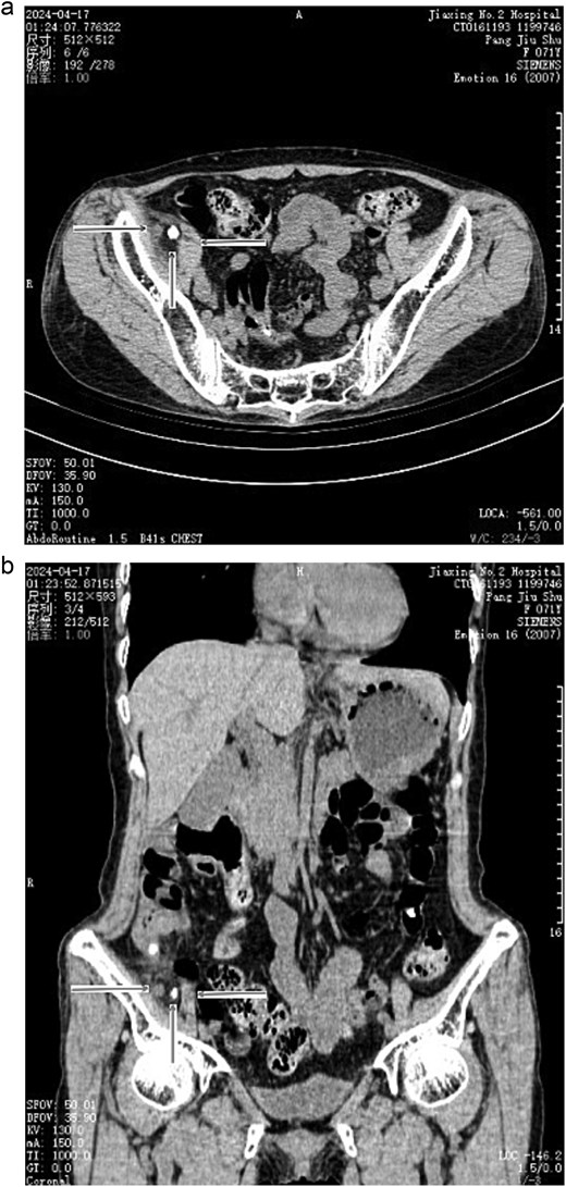 (a) Preoperative CT scan indicated acute appendicitis and calcification beside the appendix (transverse section). →: Appendix; ↑: Calcification; ←: Psoas muscle. (b) Preoperative CT scan indicated acute appendicitis and calcification beside the appendix (coronal section). →: Appendix; ↑: Calcification; ←: Psoas muscle.