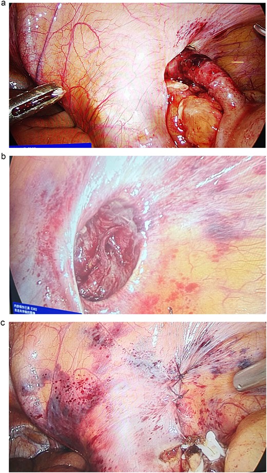 (a) Lateral hernia of the right psoas muscle, with the appendix herniating and incarcerated. (b) The hernial sac was exposed with a 3 cm depth and a 2 × 1.5 cm neck. (c) The hernial sac was closed with interrupted sutures.