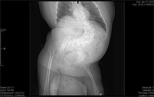 Dextroscoliosis with marked rotation of vertebral bodies, displaced right femoral head and giant inguinal hernia.