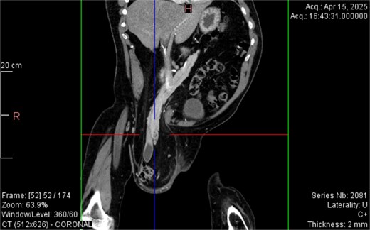 Coronal CT view inguinal hernial sac with pancreatic head and D2 and D3 segment of duodenum.