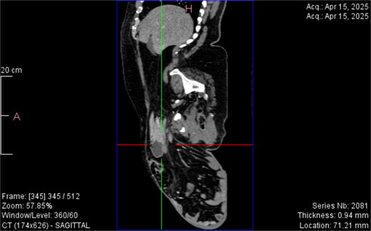Sagittal CT view inguinal hernial sac with pancreatic head and D2 and D3 segment of duodenum.