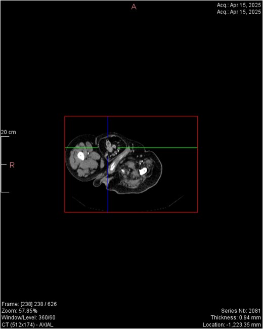 Horizontal CT view inguinal hernial sac with pancreatic head and D2 and D3 segment of duodenum.