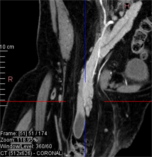 Coronal CT view visualization of vascularization of pancreatic head after i.v. contrast.