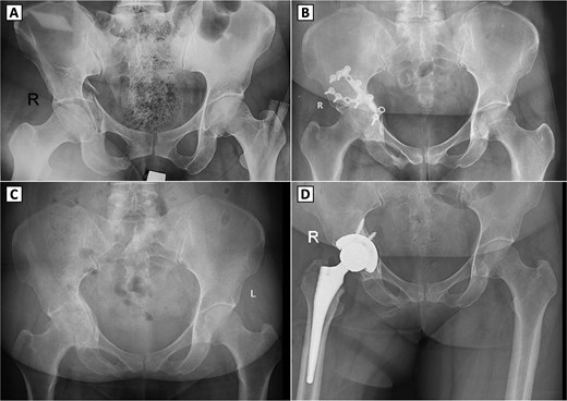 Serial radiographs of a patient with right acetabular fracture treated with open reduction and internal fixation (ORIF), followed by secondary osteoarthritis and conversion to total hip arthroplasty. (A) Preoperative anteroposterior (AP) pelvic X-ray showing a displaced right acetabular fracture. (B) Postoperative AP radiograph demonstrating internal fixation with reconstruction plates and screws on the right acetabulum. (C) Follow-up AP pelvic radiograph showing signs of secondary osteoarthritis in the right hip joint, showing shows signs of secondary osteoarthritis in the right hip joint, including joint space narrowing, femoral head deformity, and subchondral sclerosis. (D) Postoperative AP radiograph after conversion total hip arthroplasty with a cementless prosthesis and screw fixation.