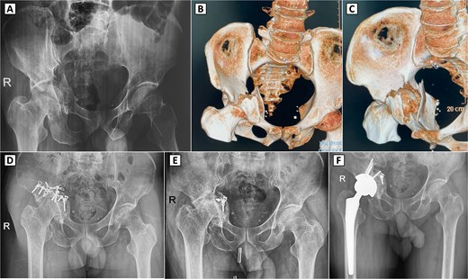 Preoperative imaging, 3D CT reconstruction, and postoperative radiographs with complex right acetabular fracture and subsequent surgical interventions. (A) Preoperative anteroposterior (AP) pelvic X-ray demonstrating a displaced right acetabular fracture with protrusion of the femoral head into the pelvis. (B, C) 3D computed tomography (CT) reconstructions (anterior and superior views, respectively) revealing the comminuted acetabular fracture involving the posterior column and posterior wall. (D) Postoperative AP pelvic radiograph showing internal fixation of the right acetabulum with reconstruction plates and screws. (E) Radiograph after hardware removal, with partial retention of fixation material, demonstrating secondary osteoarthritis of the right hip joint, including joint space narrowing and femoral head deformity. (F) Postoperative X-ray following the conversion total hip arthroplasty.