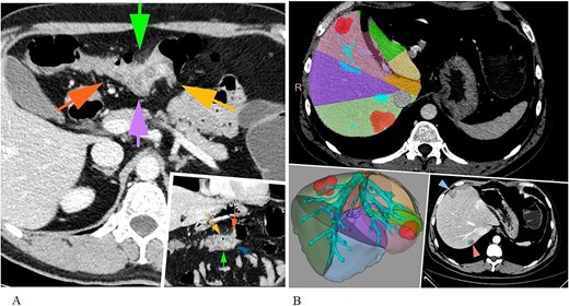CT abdomen revealing a primary colon tumour (A) and liver metastases (S7, S4inf) (B).
