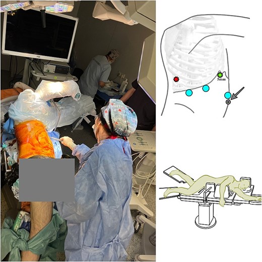 Patient's positioning on the operating table (modified left Jack-knife position) during liver resection. A 5-mm trocar was placed next to the xiphoid process, and the other two 12-mm trocars were placed at intervals of 6 cm next to the 5-mm trocar. The intercostal 5 mm trocar was placed through the ninth intercostal space on the right posterior axillary line.