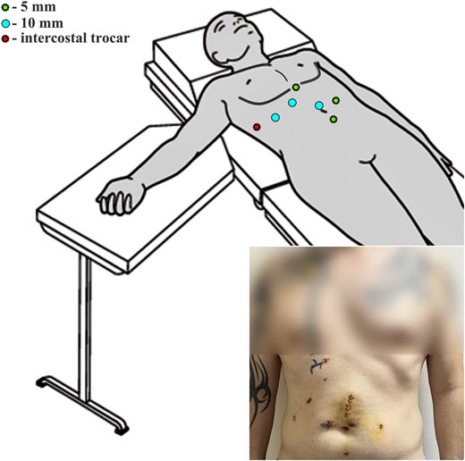Graphic representation of the patient's positioning on the operating table (supine position) during colon resection and final view on the fifth postoperative day.