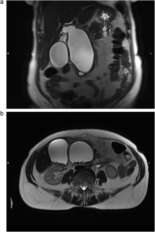 MRI, T2-weighted scan. Todani type IA biliary cyst. (a) Coronal slice: cystic dilation of CBD, diffusely dilated biliary tree; (b) axial slice: multiple CBD and gallbladder stones.