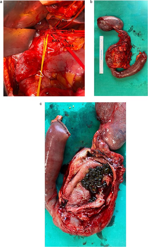 (a) Intraoperative view during dissection of the hepatoduodenal ligament showing common hepatic artery branches (single arrows), CHD (central tie) and CBD cyst (double arrows); (b) resected biliary cyst with the pancreatic head, duodenum, proximal part of jejunum and gallbladder; (c) dissected cyst containing multiple gallstones.