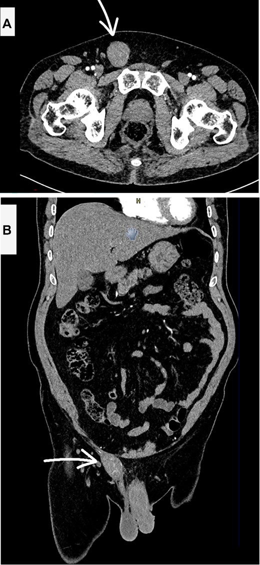 Contrast enhanced CT scan abdomen and pelvis (A—axial and B—coronal views) showing the suspicious inguinal mass (white arrow).