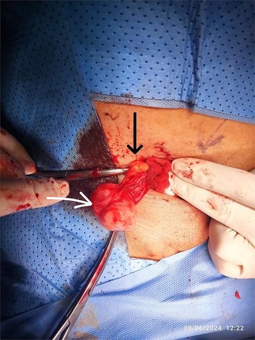 Intraoperative view of the RT inguinal mass (white arrow), cord structures (black arrow).