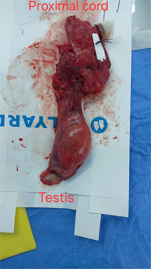 Radical orchidectomy specimen, with marked inferior resection margin.