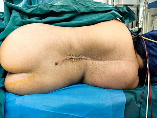 Patient positioning demonstrating spinal curvature.