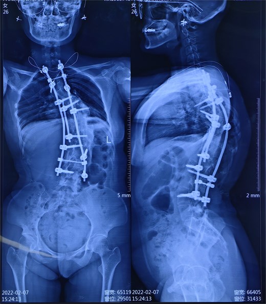 Radiographs showing thoracolumbar instrumentation and residual scoliosis.