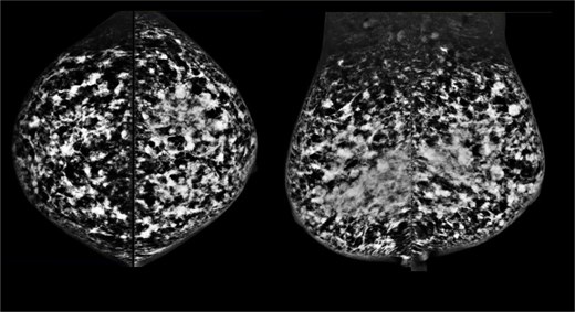 October 2015: Mammography images; craniocaudal views (left), mediolateral oblique views (right).